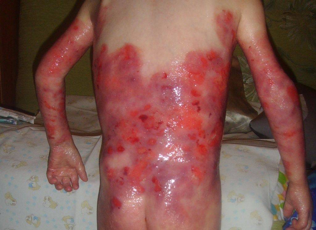 Пограничнй_буллезный_эпидермолиз.jpg