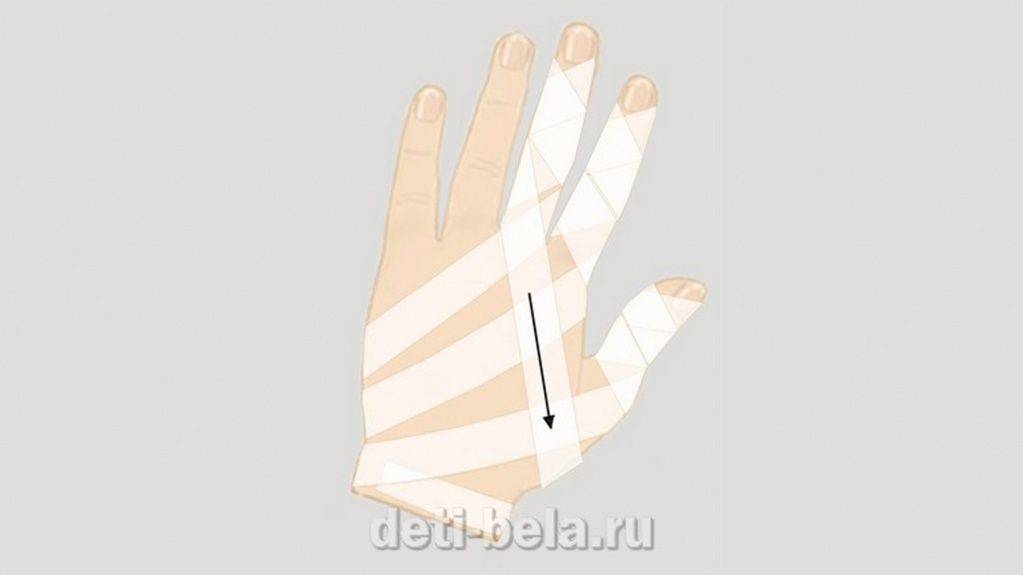 Бинтование6.jpg
